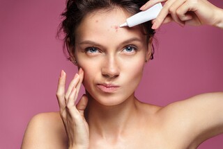 טיפול טבעי באקנה 